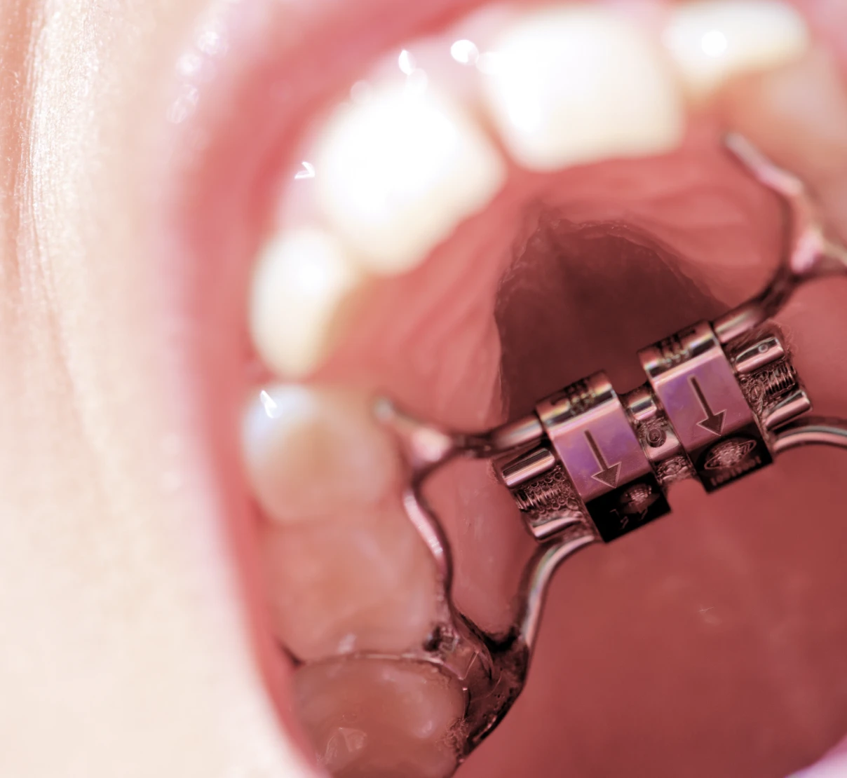 L'activation du disjoncteur à Thionville