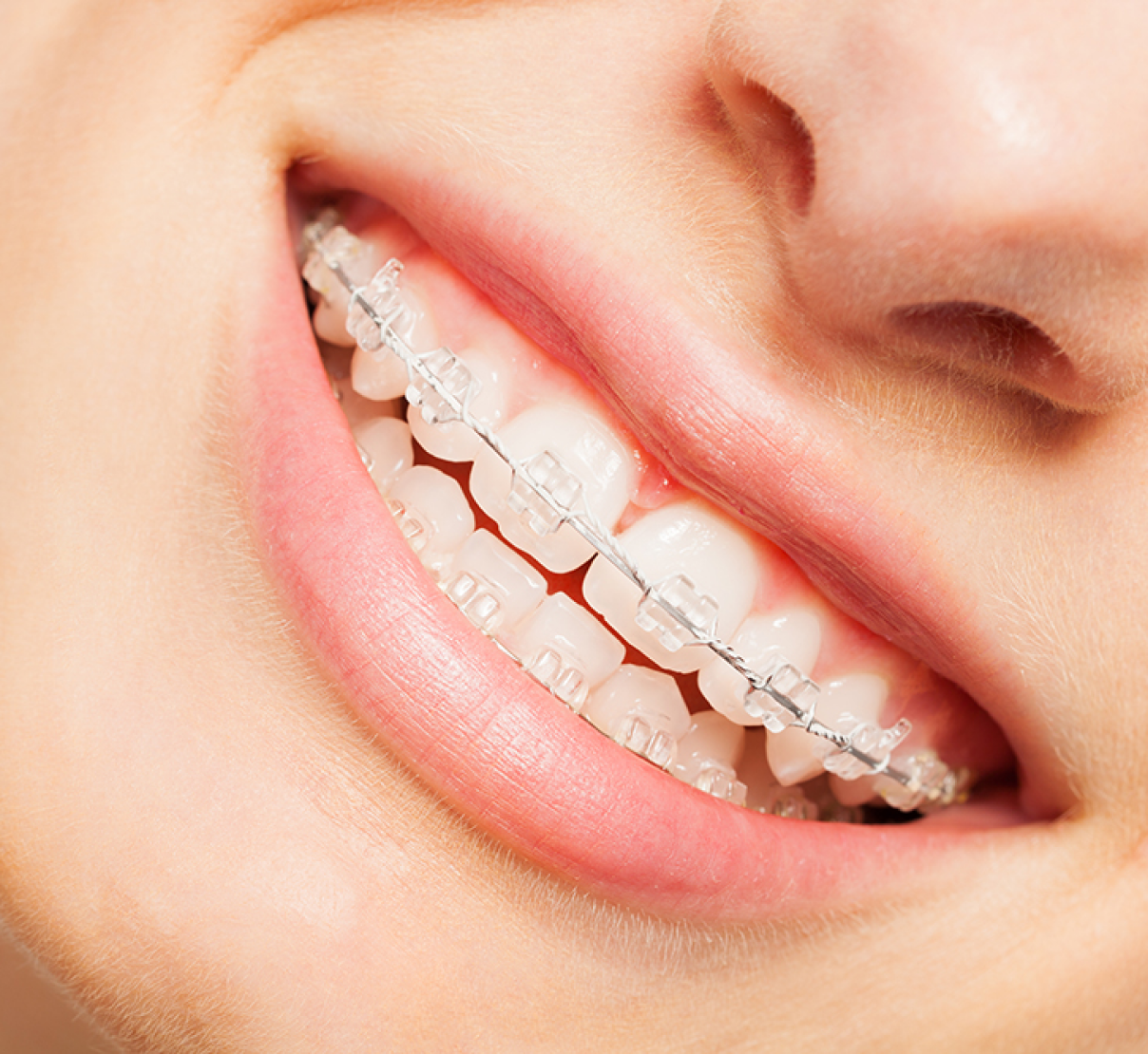 Multi-bagues céramiques au Cabinet d'orthodontie du Docteur Py à Thionville