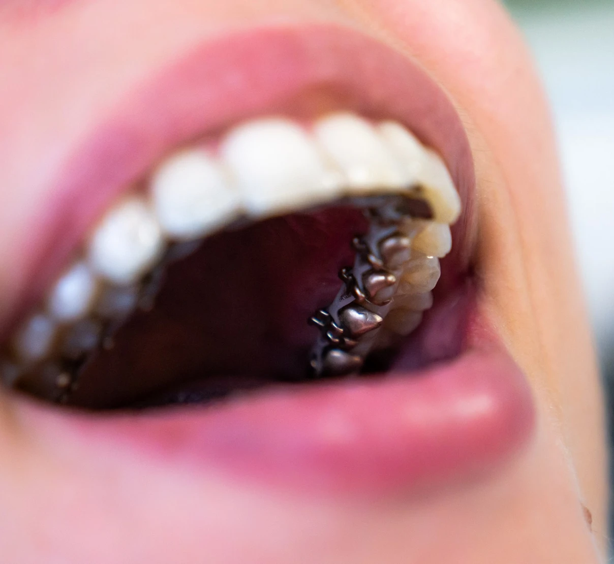 Illustration de l'utilisation des multi-bagues en lingual au Cabinet d'orthodontie du Docteur Py