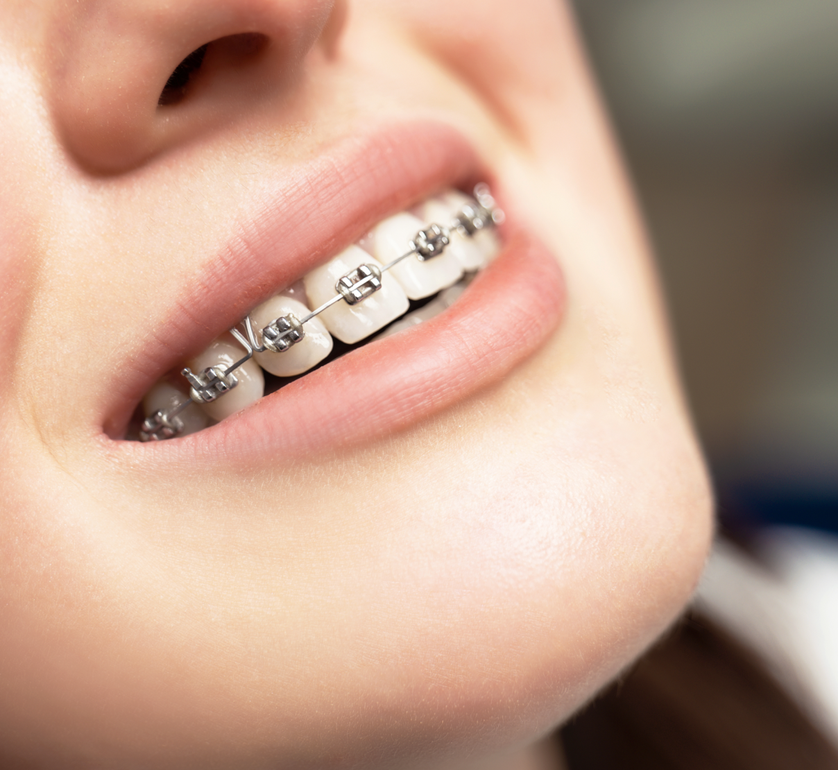 Les multi-bagues en métal au Cabinet d'orthodontie du Docteur Py