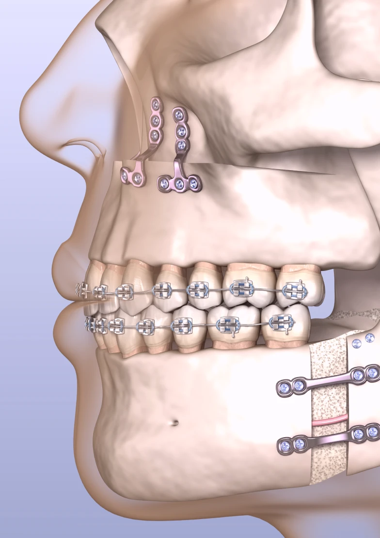 L'exemple de l'orthodontie chirurgicale