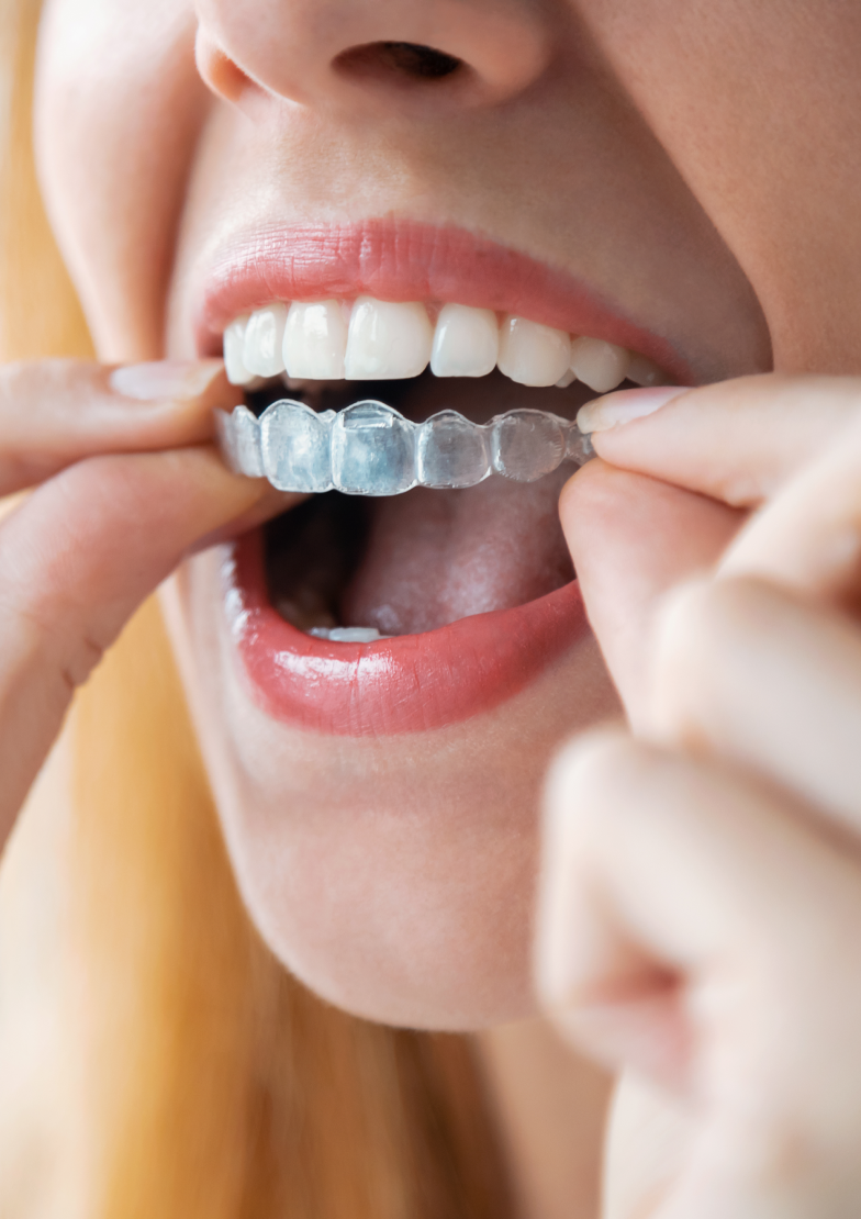 La pose des gouttières au Cabinet d'Orthodontie du Docteur Catherine Py à Thionville