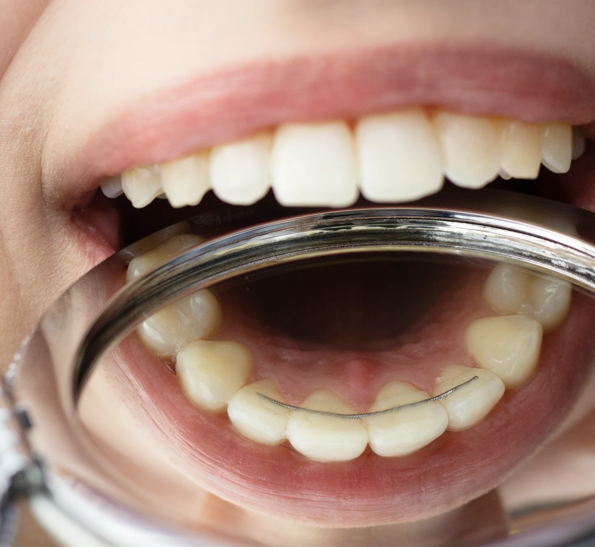 Fil de contention orthodontique garantissant la stabilité des dents après un traitement, fabriqué au laboratoire du Docteur Py.